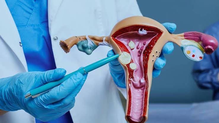 Uterine fibroid explained on a uterus model